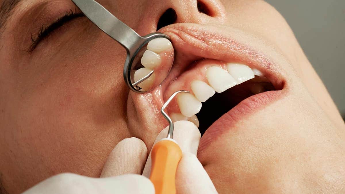 Examen des gencives avec miroir et sonde parodontale
